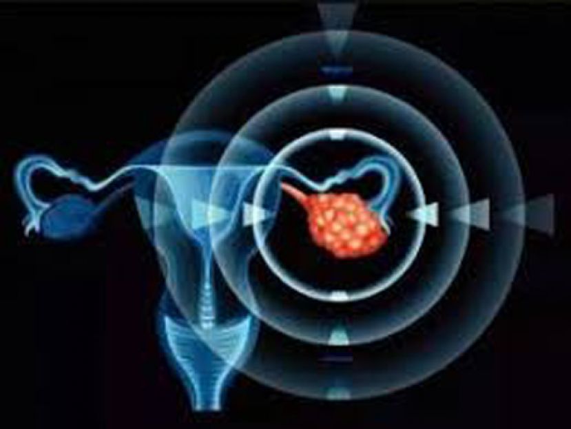 复健师卵巢癌指数破万　医师为她做了这三件事逆转病情