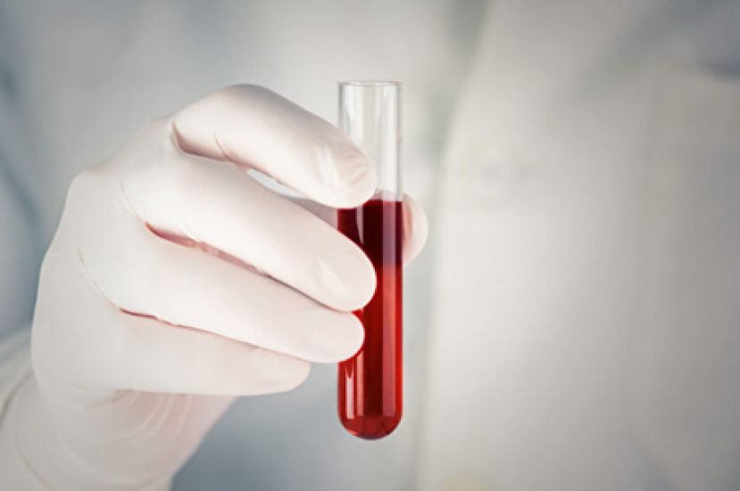 急性骨髓性白血病有四大症状