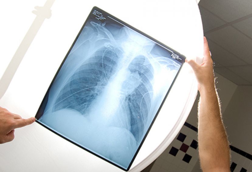 41岁男不烟竟肺癌 免疫治疗病况稳