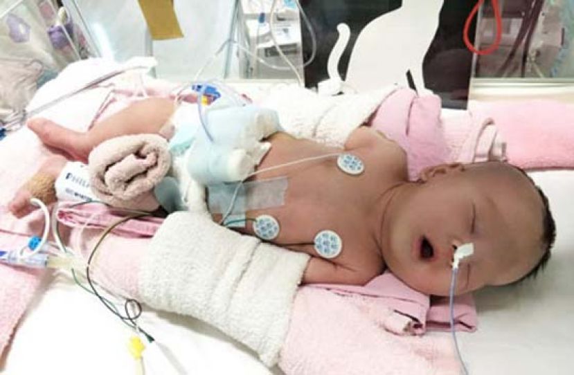 妈妈10公分肾脏植入体内　末期肾病2岁娃重生