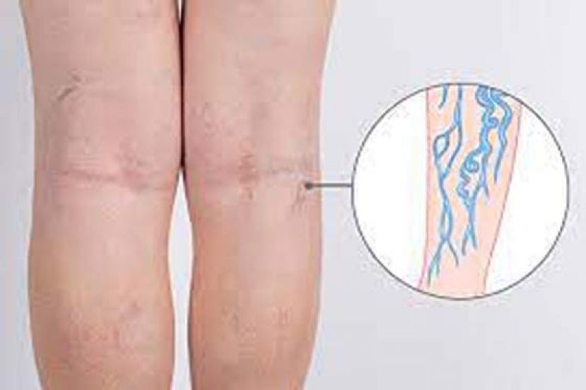 静脉曲张哪4种症状就要就医？ 一次了解精确诊断和微创治疗
