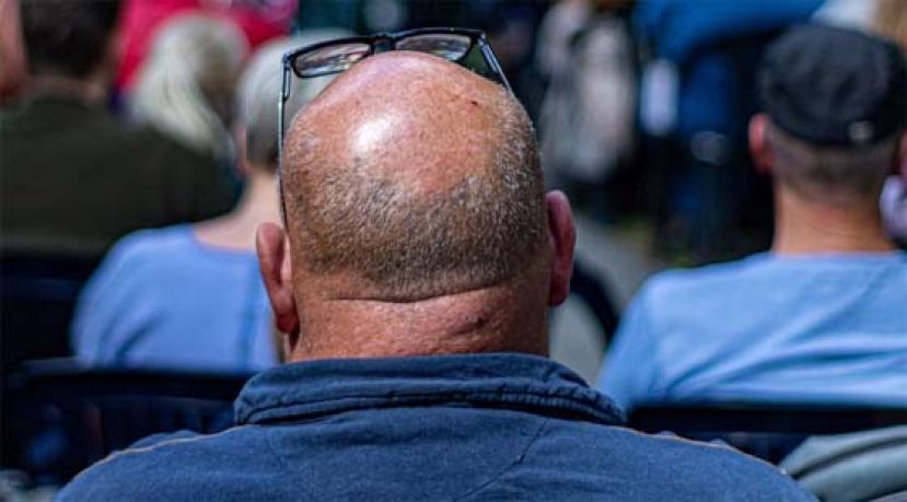 有些男士认为脱髮确实造成自信问题。（示意图）