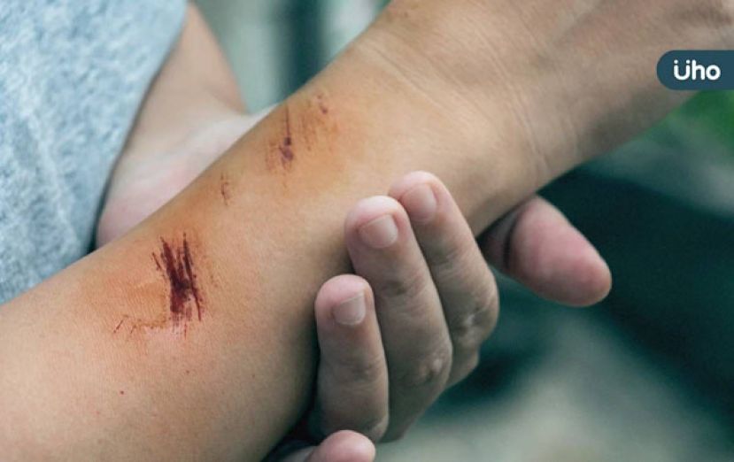 开放性外伤感染当心破伤风　年节外伤紧急处理4步骤