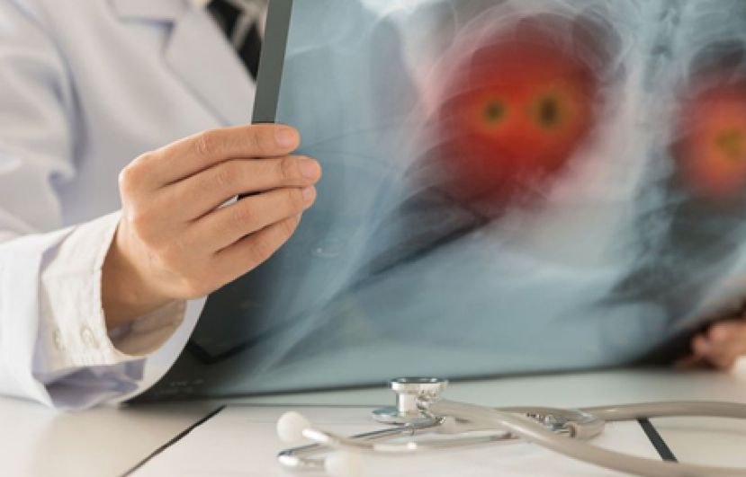 阿嬷晚期肺癌怕打针 口服化疗撑过两年超励志