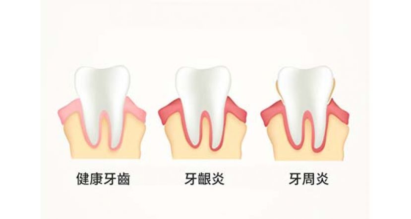 牙周病是身体慢性发炎？ 为体内灭火可防多种疾病