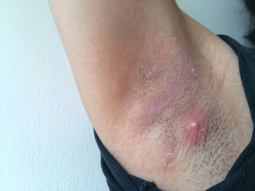 痘痘长不停　是青春痘还是化脓性汗腺炎？