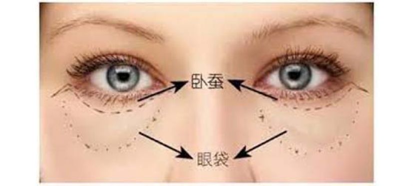眼袋显老无神怎么救？复合式眼袋手术隐密上工