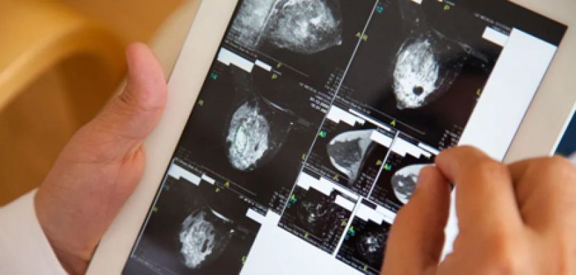 三阴性乳癌友时刻不安　新药发展提供治疗新希望