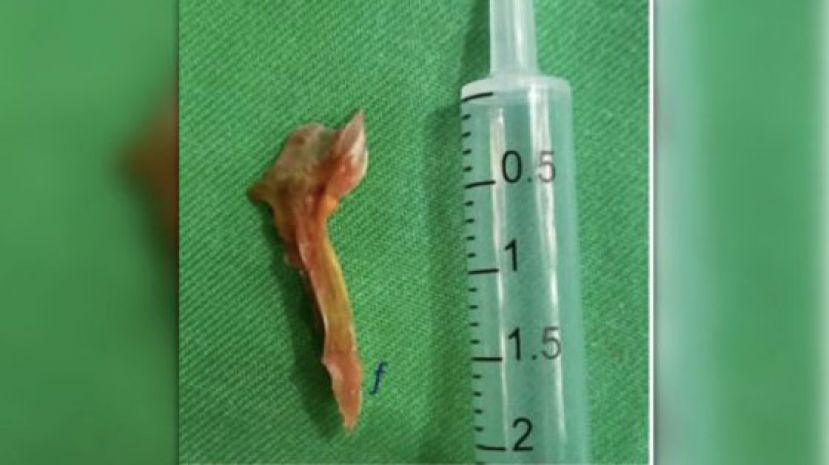 斯里兰卡一名男子腹痛三天后求医时才发现是鱼骨刺穿肠，但抢救8小时后还是死亡。