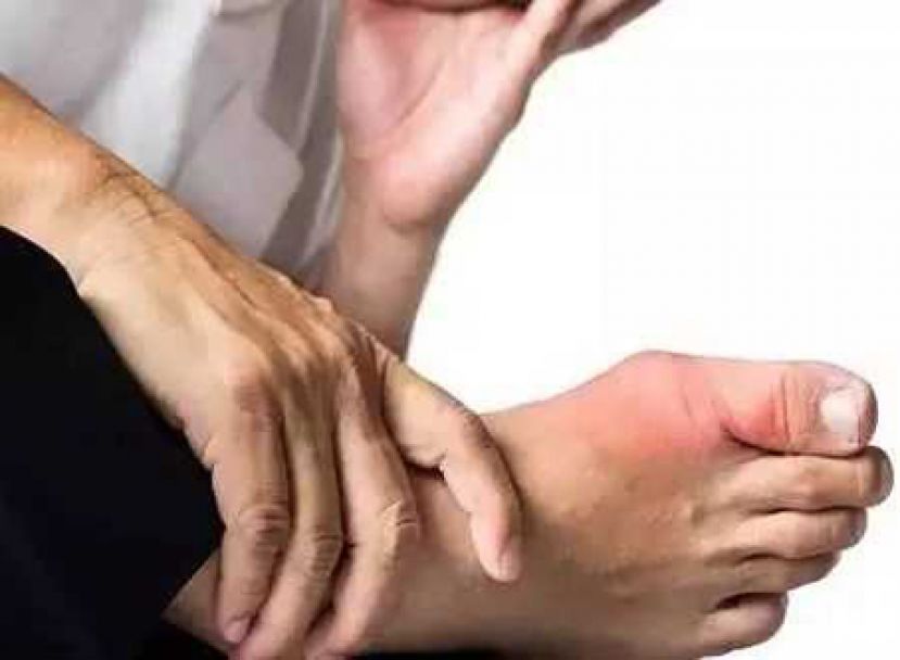 饮食失衡压力大 痛风年轻化