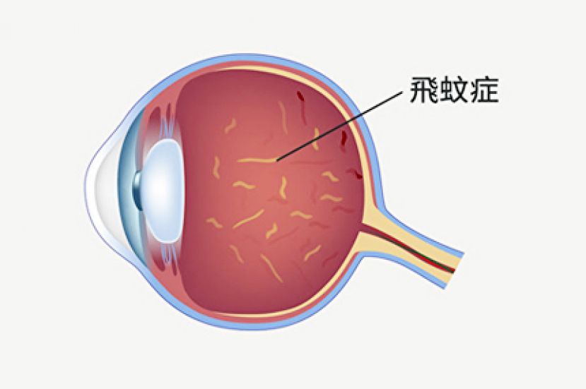 飞蚊症不是病 出现闪光当心视网膜剥离