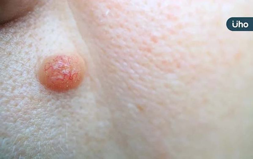 赘生皮是什么？ 医警告：严重恐造成皮肤坏死