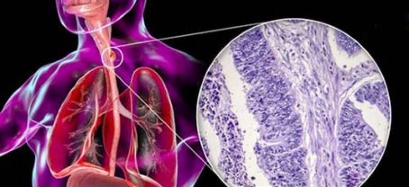 打嗝2个月停不了　竟食道癌3期