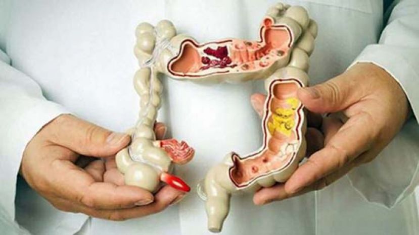 癌症发生率之冠！　90%大肠癌由 &ldquo;它&rdquo; 转变而成