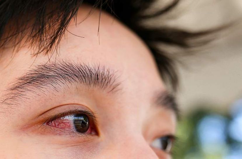 卫生部：147个结膜炎或眼痛感染群 122个感染群是发生在学校