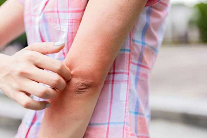 热天抓不停有3大原因 如何防范止痒？