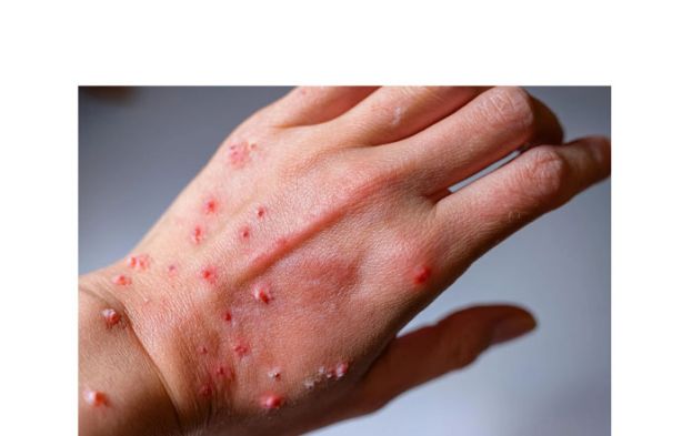 卫生部：一家四口确诊　大马出现M痘感染群