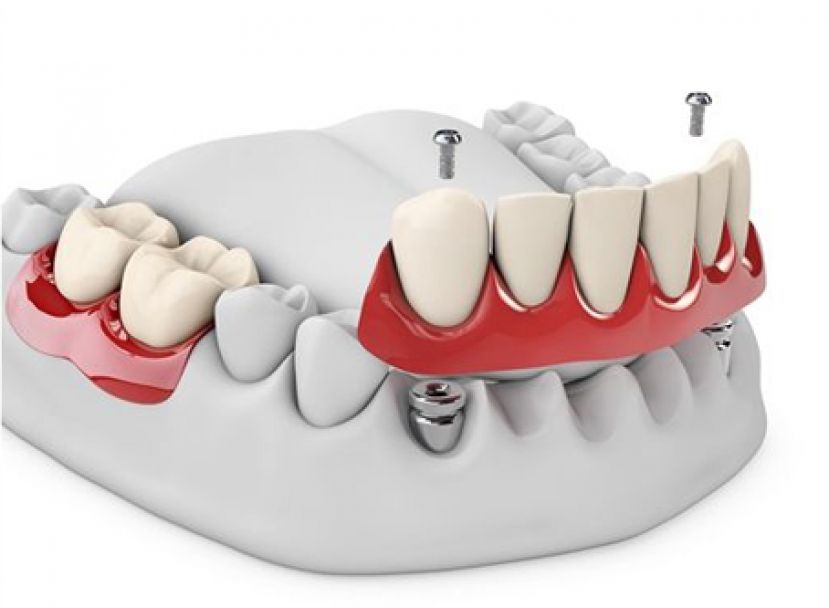植牙支撑全口覆盖式假牙 牢固稳妥当