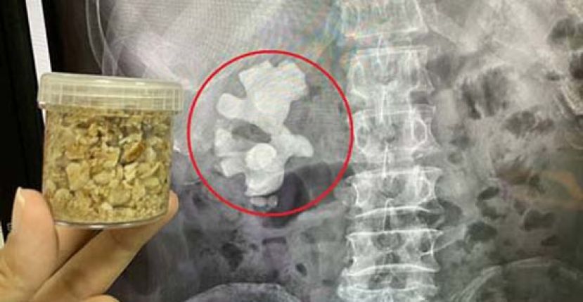 男腰痛血尿　8公分鹿角大结石阻塞肾脏