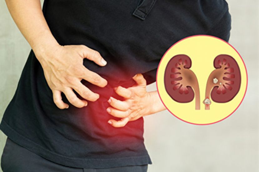 肾结石痛到一辈子忘不了 二招预防不让结石上身