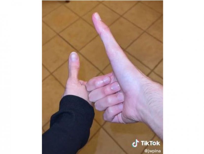 23岁男子大拇指天生有&ldquo;过人长处&rdquo;，是一般人的2倍。