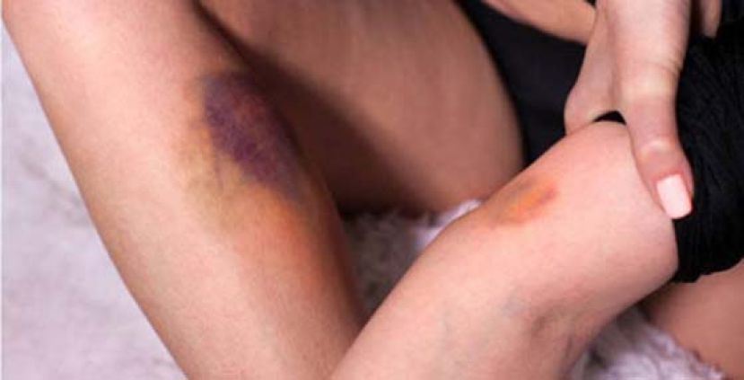 人妻全身瘀青如巴掌大　C肝口服药助挥别家暴疑云