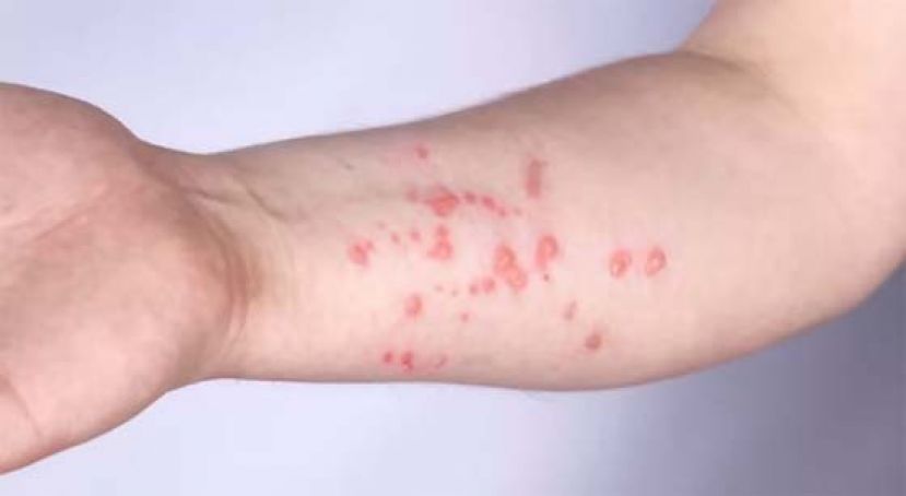 泰国猴痘累计559例，2人死亡。