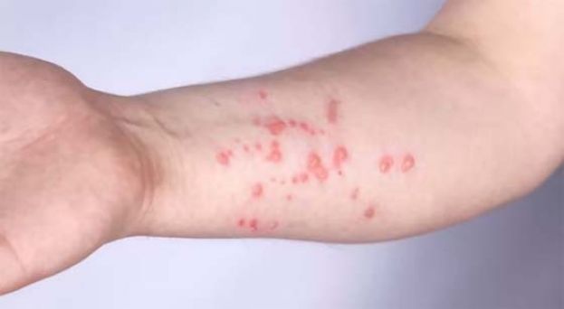 泰国猴痘累计559例，2人死亡。