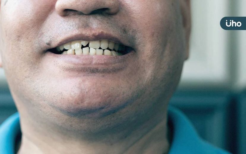 牙医教假牙清洁2招　防感染真牙流失