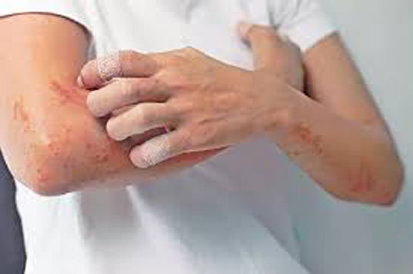 中医换肤方2.0  十年湿疹竟康复