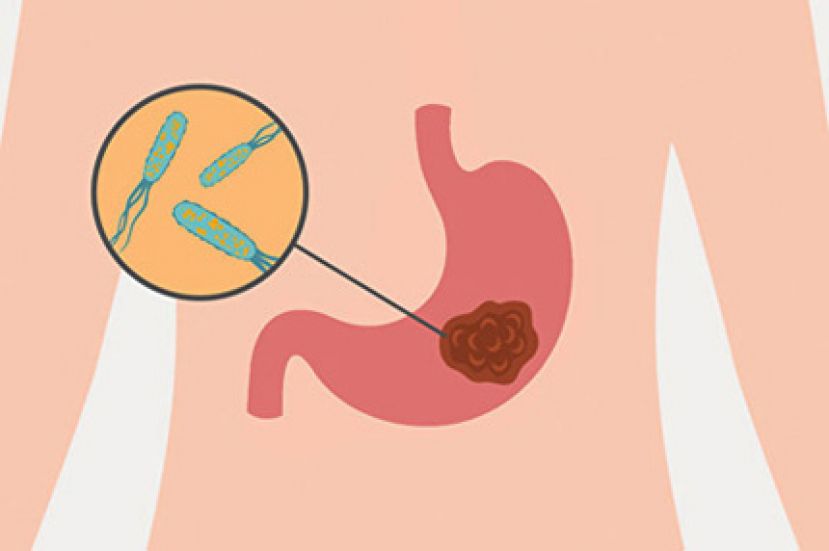 幽门杆菌是胃癌主凶 三招防治