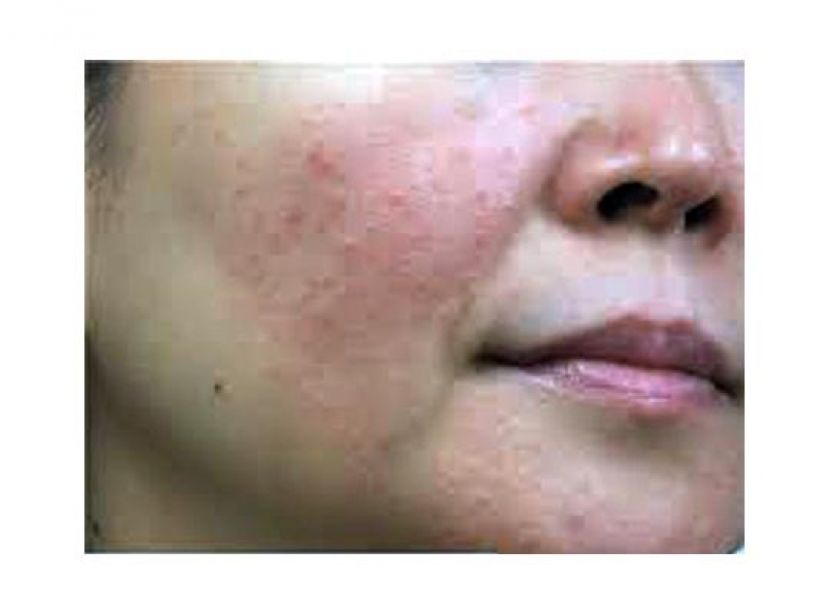 高温引发玫瑰痤疮 宜做防晒少饮酒