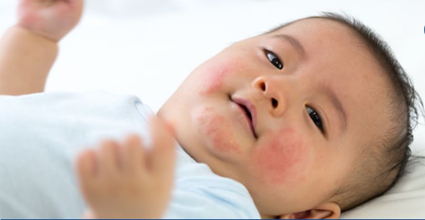 儿童急性蕁麻疹难治　竟是霉浆菌作怪