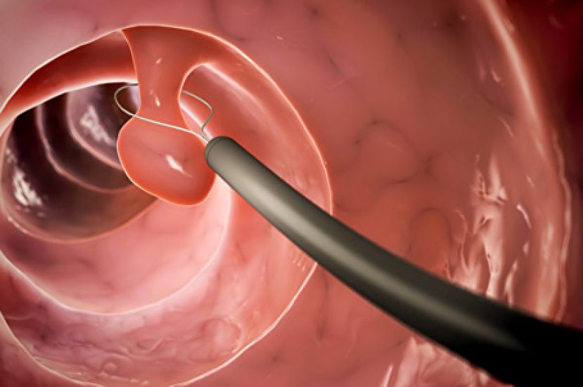 做大肠镜能预防肠癌吗？关于大肠镜的10问