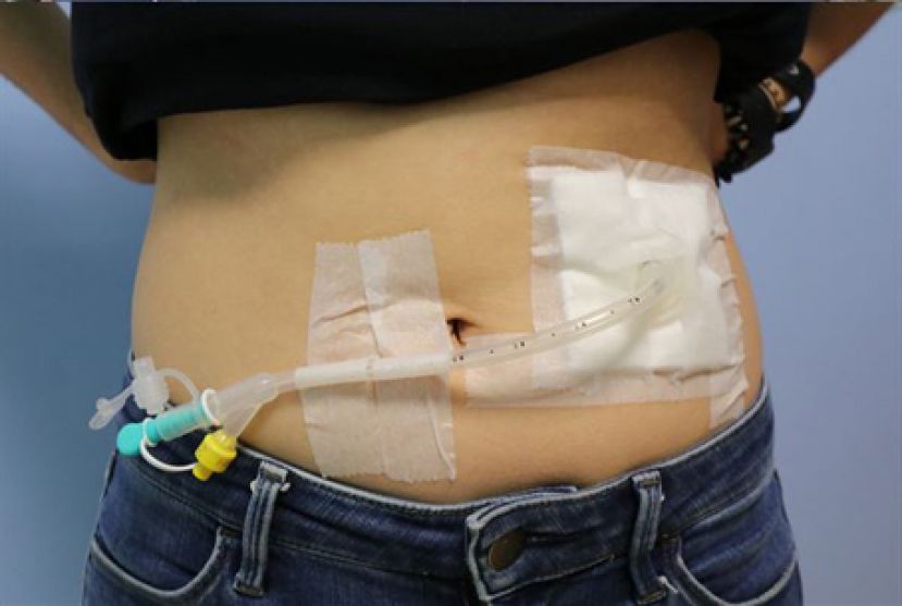 胃造口取代鼻胃管 有助提升生活品质