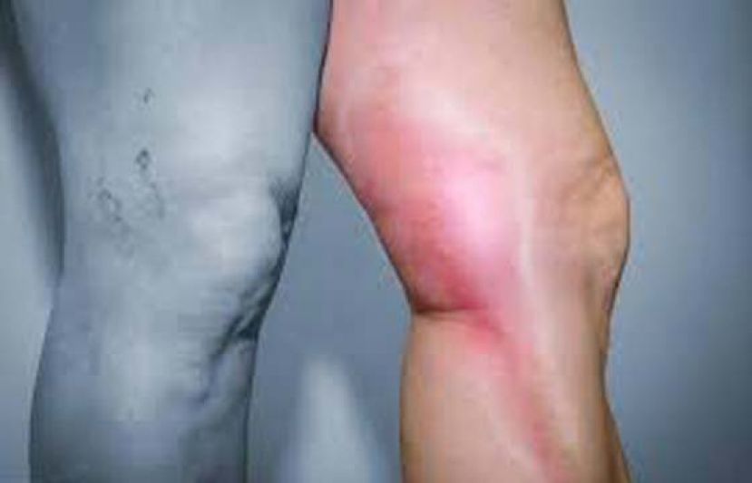 腿部血管暗藏危机?　当心周边血管动脉阻塞、静脉曲张