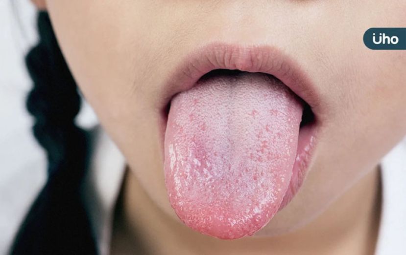 舌苔黄正常吗？　需要每天刷？　8种舌象自我检测