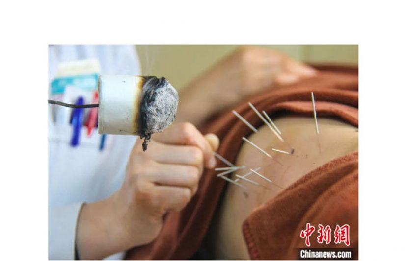 河南省南阳市中医院医师在给患者进行腿部传统针灸治疗。