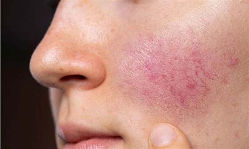 寻找玫瑰女孩　酒糟这样保养重拾好肤质