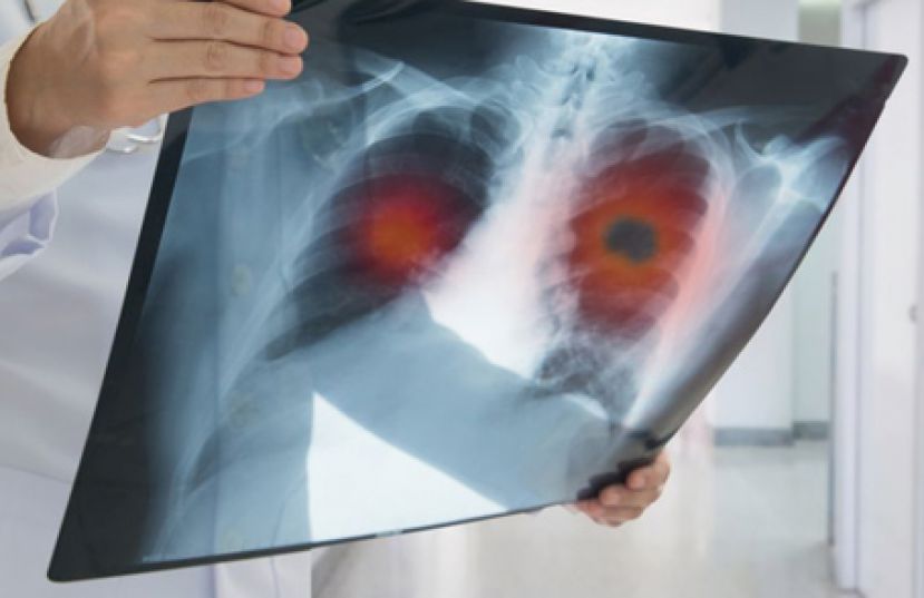 沉默杀手肺腺癌 国际标靶治疗新趋势