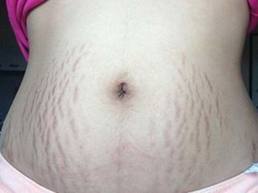 3宝妈健身5年仍有妊娠纹　腹部拉皮重振信心