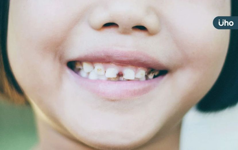 &ldquo;多生牙&rdquo;一定要拔吗？  医评估5关键