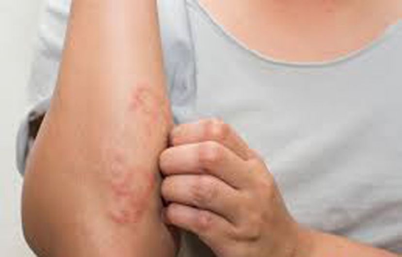 预防异位性皮肤炎复发 平时做好保湿适当用药