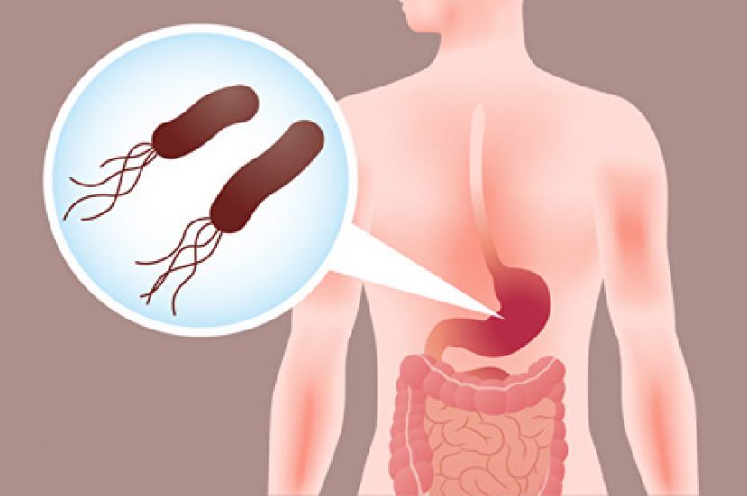 经常胃痛胃胀？元凶可能是幽门螺旋杆菌