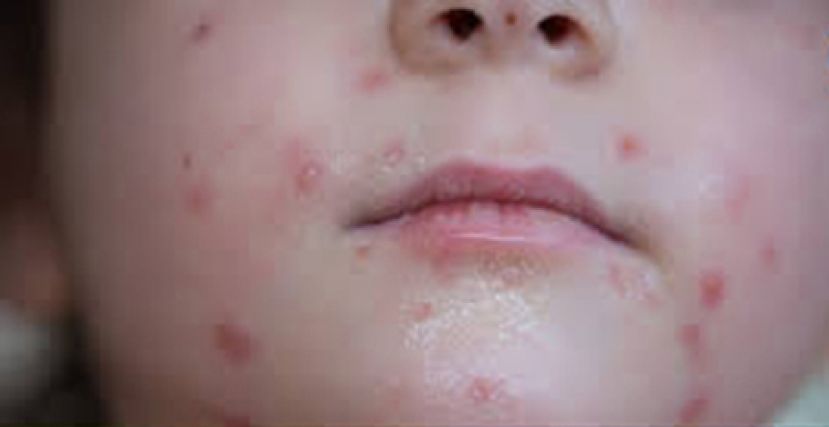 少年得老人病　类天疱疮爬全身痛又痒