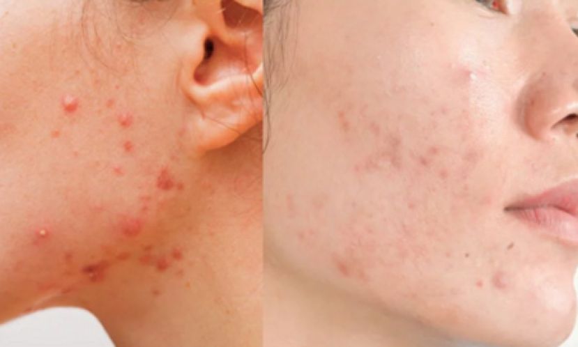 放任痘痘 当心留疤变沧桑脸