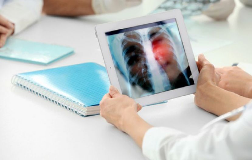 找出变异基因对症下药 大幅减缓肺癌恶化延长寿命