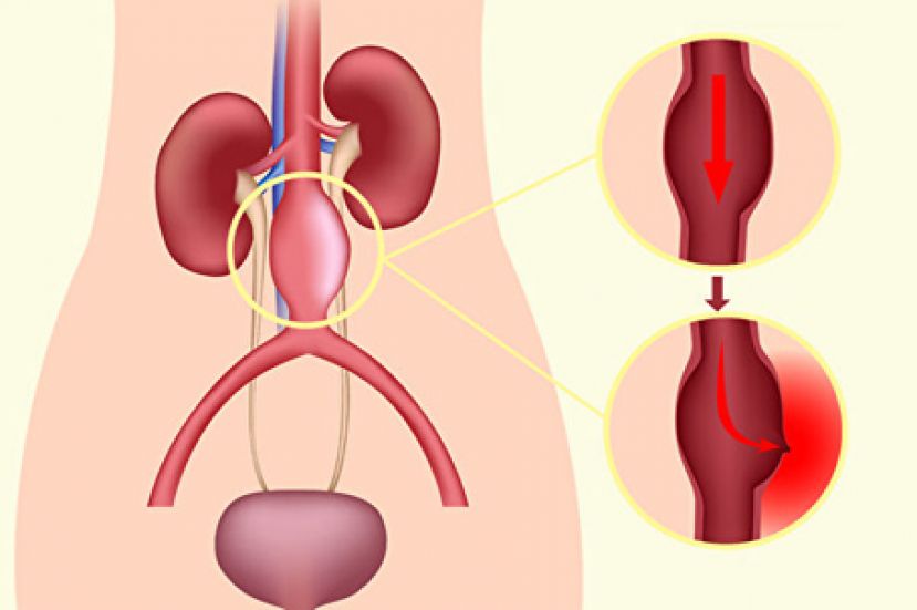动脉瘤越大越易破裂 哪些症状要警惕？