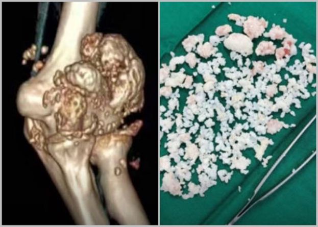 每天玩手机10小时，26岁男手肘长出千颗&ldquo;珍珠&rdquo;。