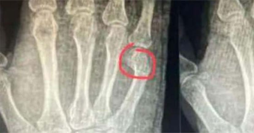 爸教儿子做功课，气到捶断自己手掌。